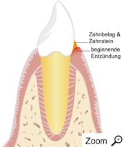 Beginn einer Entzündung